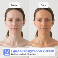 Zichtbaar resultaat van de gezichtsbruiner na vijf sessies
